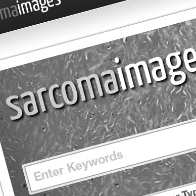 Sarcoma Images